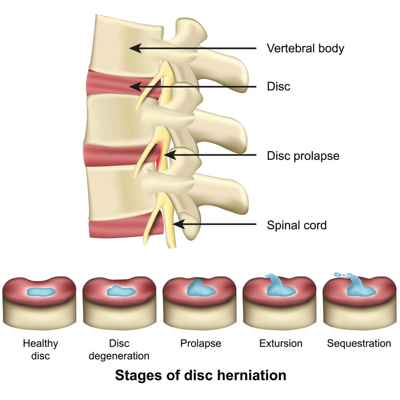 Learning About Neurogenic Claudication